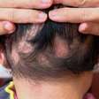 O que causa alopecia? Veja os principais fatores por trás da queda capilar