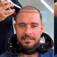 Diogo Nogueira raspa o cabelo e levanta suspeita de novo transplante capilar; especialista detalha procedimento, cada vez mais popular em famosos: 'Deixou de ser tabu'