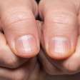 Um sinal discreto nos dedos pode estar ligado ao pulmão; veja qual é