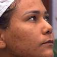 Pele acneica: quais são os cuidados ideais para quem tem, como Chaiany, eliminada do 'BBB 26'? Cosmetóloga faz alerta e revela hábito indispensável na rotina de skincare
