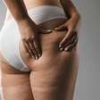 Lipedema: por que dieta e exercício não são suficientes