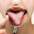 Língua branca? Saiba o que a cor da sua boca revela sobre sua saúde