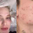 'Sai sangue': Virginia Fonseca expõe acne severa ao resgatar foto antiga e revela tratamento intenso para evitar marcas no rosto