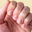 Manchas brancas nas unhas: por que a leuconíquia pontuada quase nunca indica falta de vitaminas ou cálcio