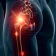Ciática ou dor muscular? Especialista revela como diferenciar os sintomas e acelerar a cura