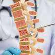 Osteoporose: médica alerta para sinais que surgem muito antes da primeira fratura