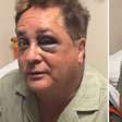 O que aconteceu com o olho de Leonardo? Médico explica hematoma assustador