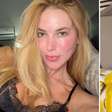 Virginia aparece com o rosto 'em carne viva' e especialista alerta: 'Devemos ficar atentos'