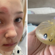 Menina de 10 anos queima rosto após fazer trend do TikTok com brinquedo