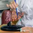 Hepatite silenciosa: saiba como identificar os sinais e se prevenir
