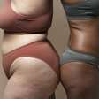 Lipedema: entenda o tratamento, que envolve cirurgia e nutrologia