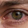 Triquíase: problema nos cílios pode causar irritação e desconforto ocular