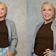 Xuxa revela que fez transplante capilar; entenda o procedimento