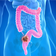 O rastreamento do câncer colorretal mudou no Brasil: SUS adotou um novo teste caseiro que antecipa o diagnóstico do câncer de intestino com tecnologia super sensível ao sangue invisível