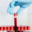 Pesquisa em psiquiatria molecular identifica sinais biológicos associados à depressão, mas diagnóstico por sangue ainda é futuro