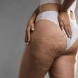Estudo reforça segurança da lipoaspiração para lipedema