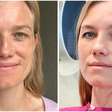 Melasma controlado: empresária surpreende com antes e depois