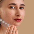 Adesivos para espinhas funcionam mesmo? Dermatologista responde