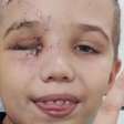 Ajudar um príncipe a tratar a recuperação da visão