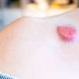Prevenção ao Câncer de Pele Não Melanoma: Alertas e Cuidados