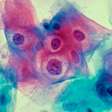 Os entraves para o avanço da vacinação contra o HPV no Brasil