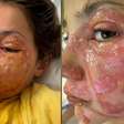 Menina de 10 anos sofre queimaduras graves no rosto após reproduzir desafio viral de rede social