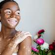 Dia Mundial do Vitiligo: médica alerta para cuidados que protegem a pele
