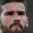 O que Alisson tem no rosto? Doença crônica sem cura afeta pele do goleiro do Brasil na Copa 2026; médico explica diagnóstico e aponta cuidado especial: 'Protetor solar'