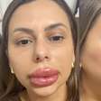 Confeiteira posta vídeo com inchado fora do comum após preenchimento e viraliza: 'Riram da minha cara'
