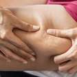 Anticoncepcional causa celulite? Especialistas explicam polêmica