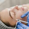 Baby botox cresce no Brasil por resultados naturais e preventivos