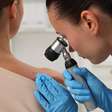 Entenda os sinais de alerta em pintas para prevenir o melanoma