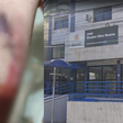 Pai presta queixa contra escola de Santos após filho com TEA cortar braço e levar 13 pontos