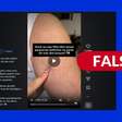 É falso que 'bolinhas' na pele de crianças sejam sintoma de parasitas intestinais