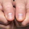 Como a falta de vitaminas afeta sua pele e unhas