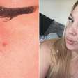 Ela conviveu anos com uma "espinha" no rosto até descobrir o que realmente era