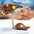 Aumentos precoces de glucagon no diabetes tipo 2 estão ligados à esteatose hepática