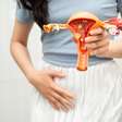 Estilo de vida também pode influenciar a gravidade dos sintomas da endometriose
