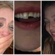 Jovem quebra dente em balada, vai ao dentista de madrugada e volta para a festa; vídeo viraliza