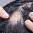 O que é alopecia? Conheça os tipos, causas e tratamentos para a queda de cabelo