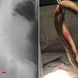 Homem é internado em estado grave após enguia entrar pelo reto e perfurar intestino
