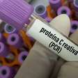 Proteína C reativa alta significa doença? O que o exame de PCR realmente mostra