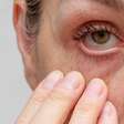 Olhos secos na menopausa? Alterações hormonais podem explicar o problema