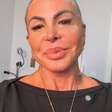 Gretchen mostra recuperação após transplante capilar: 'Olha como estou bem'