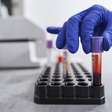 Exames de sangue podem prever o início dos sintomas de Alzheimer com anos de antecedência