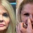 Monique Evans mostra resultado uma semana após rejuvenescimento facial: 'Novo rosto'