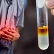 Amilase alta significa pancreatite? O que o exame realmente pode indicar