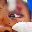 Menino de 6 anos atingido em tiroteio no RJ perde a visão do olho esquerdo
