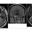 Uma luta pela vida: a busca por apoio para a cirurgia de um meningioma