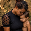 Aos 22 anos, Tamires busca cirurgia após ter 70% do corpo queimado quando era bebê